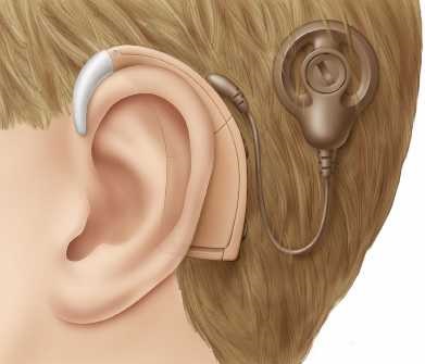 Signal Coding for Cochlear Implants