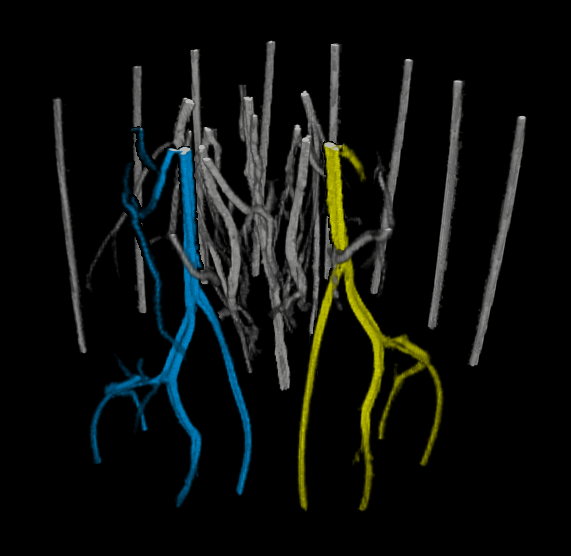 Analysis of Angiographies