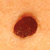 Skin Cancer Screening